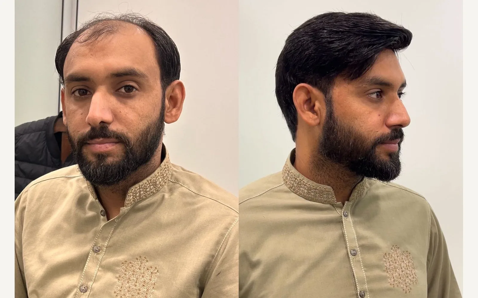 Does a Hair Patch Really Look Natural?