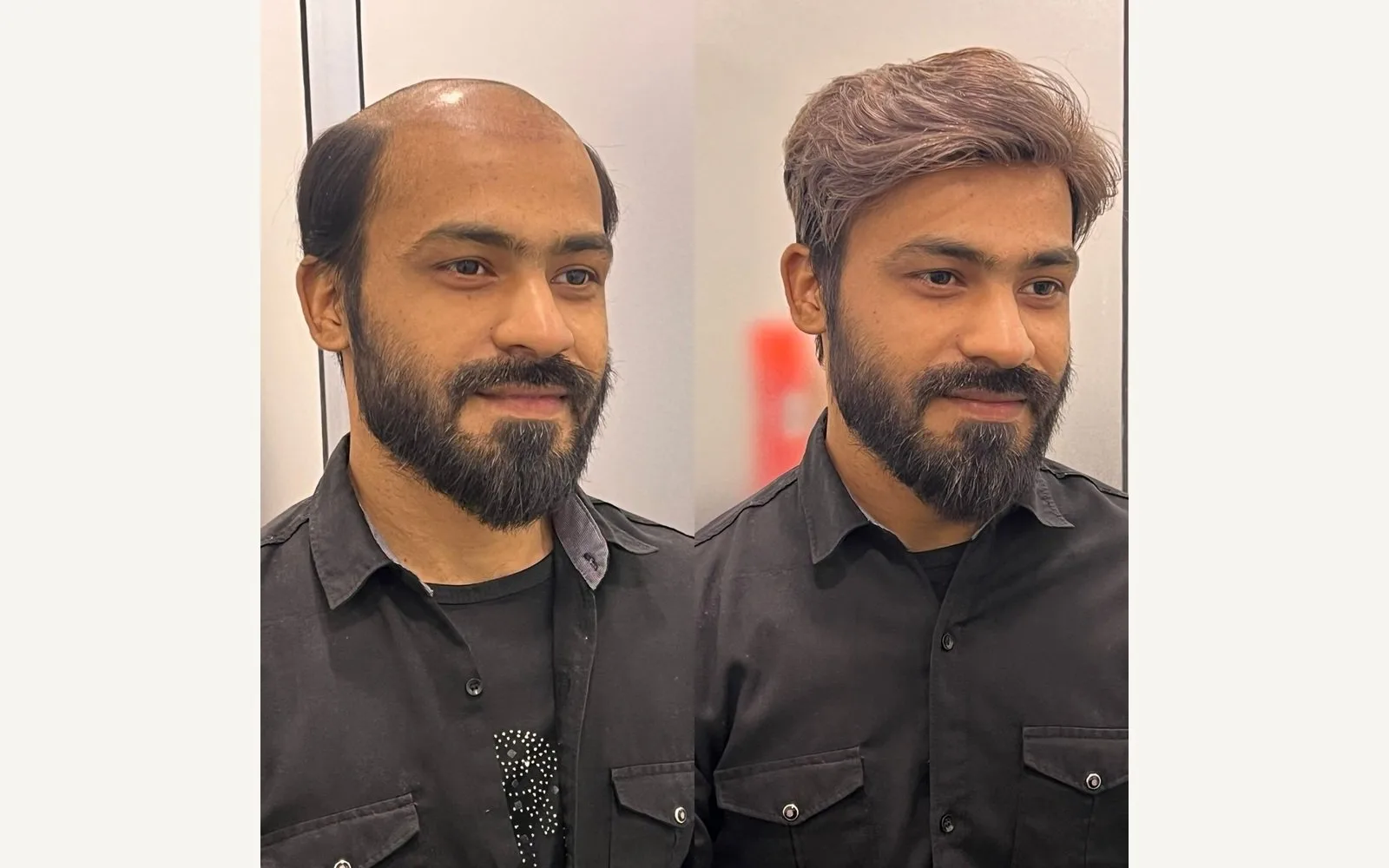 Hair Patch or Hair Transplant?