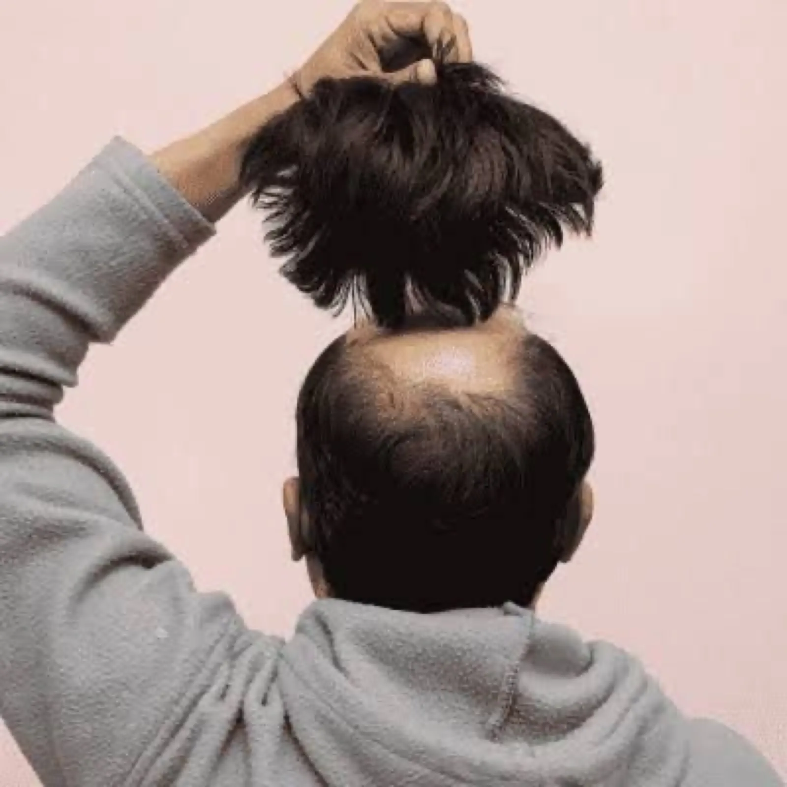 Non-Surgical Hair Patch